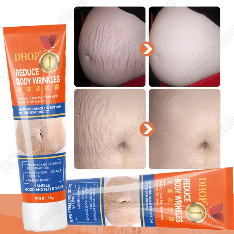 Creme de remoção permanente de estrias e anti-rugas