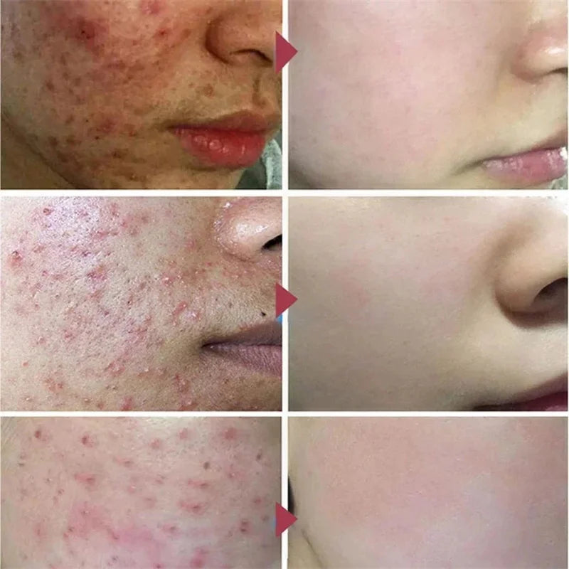 Pomada para tratamento de acne, reparação de manchas de espinhas, faz limpeza profunda dos poros. Poderoso anti-acne cicatrizante.