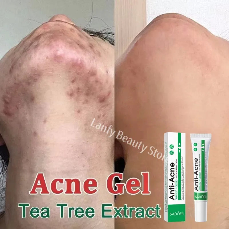 Pomada para tratamento de acne, reparação de manchas de espinhas, faz limpeza profunda dos poros. Poderoso anti-acne cicatrizante.