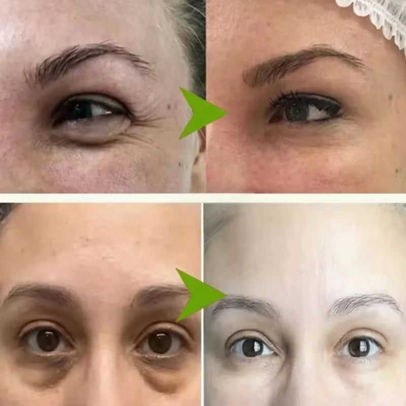 Creme para remoção de grânulos de gordura , ação delicada na área dos olhos