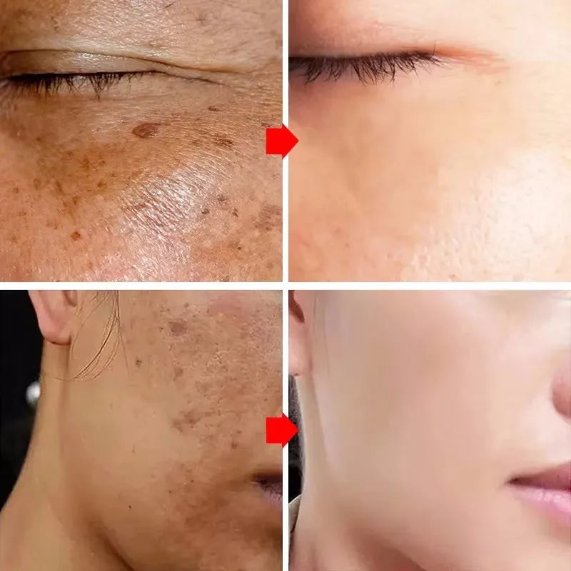 Removedor Coreano de manchas escuras, clareador de pele, sardas faciais, melanina, correção e redução de linhas finas.
