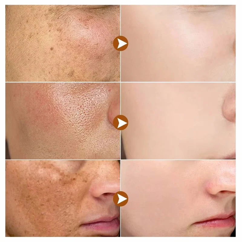 Removedor Coreano de manchas escuras, clareador de pele, sardas faciais, melanina, correção e redução de linhas finas.