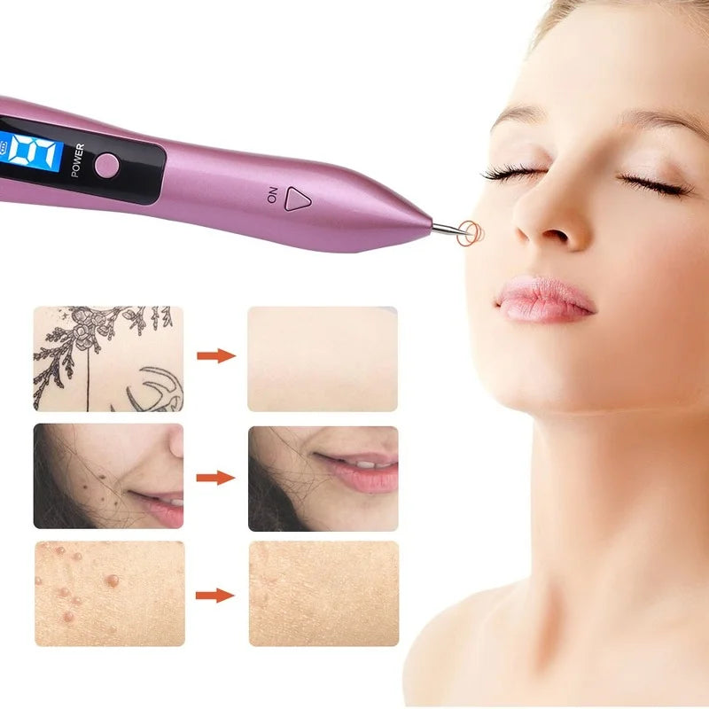 Caneta a Laser que remove manchas escuras, sardas, verrugas e até tatuagem