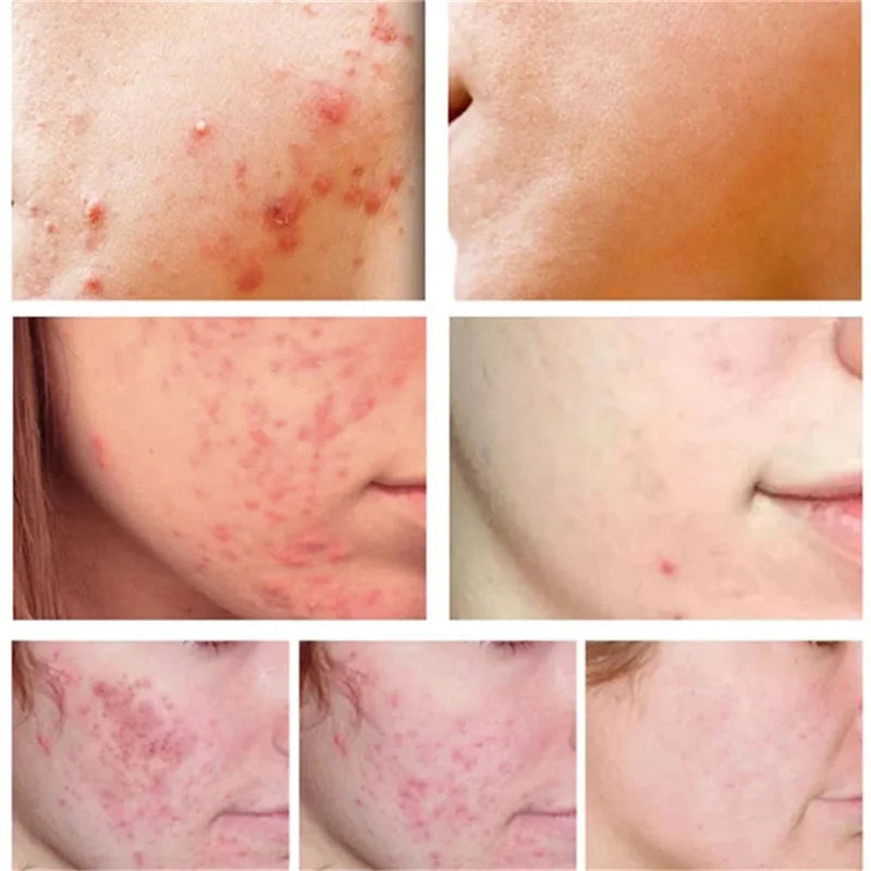 Pomada para tratamento de acne, reparação de manchas de espinhas, faz limpeza profunda dos poros. Poderoso anti-acne cicatrizante.
