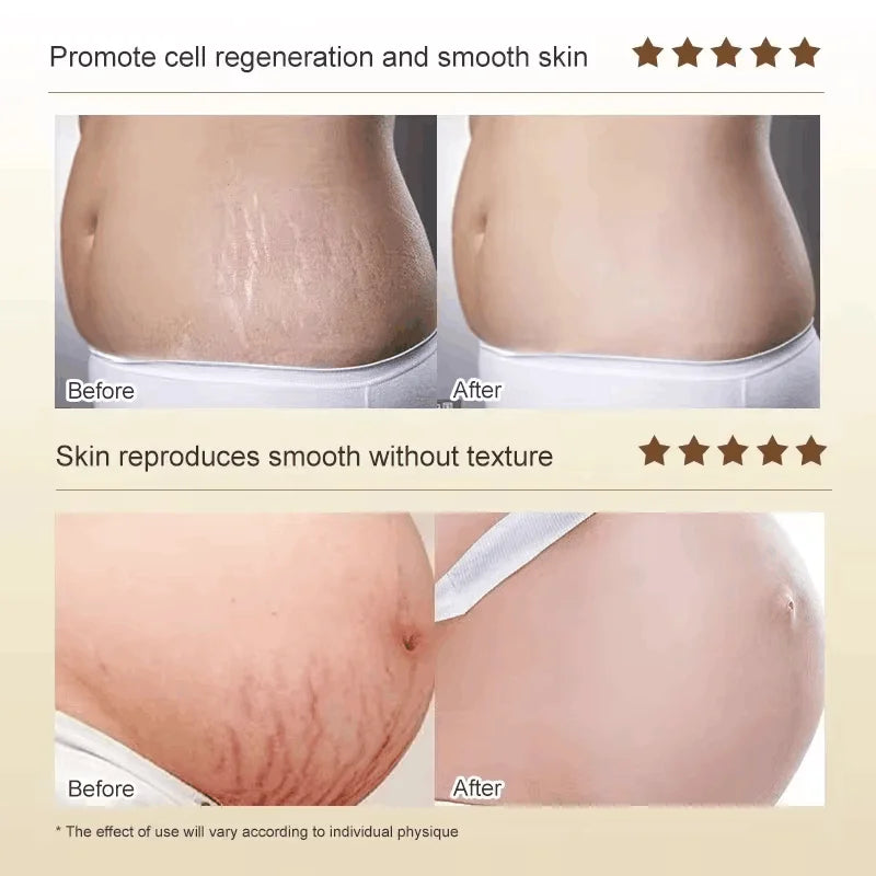 Creme de remoção permanente de estrias e anti-rugas
