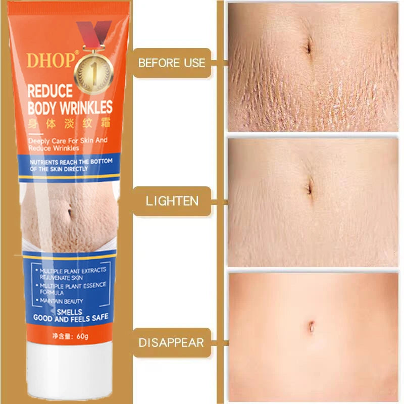Creme de remoção permanente de estrias e anti-rugas