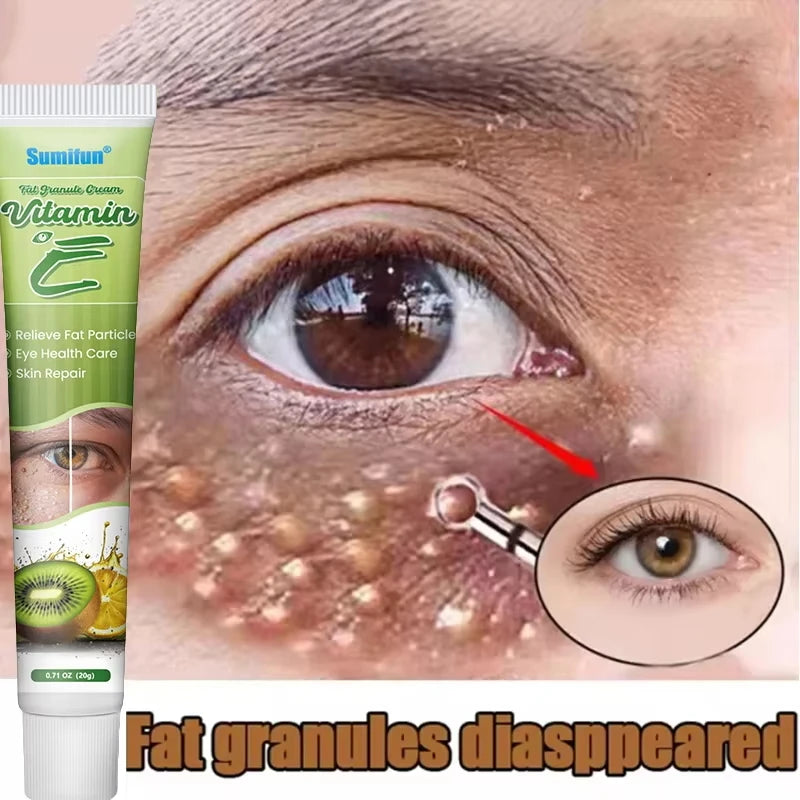 Creme para remoção de grânulos de gordura , ação delicada na área dos olhos