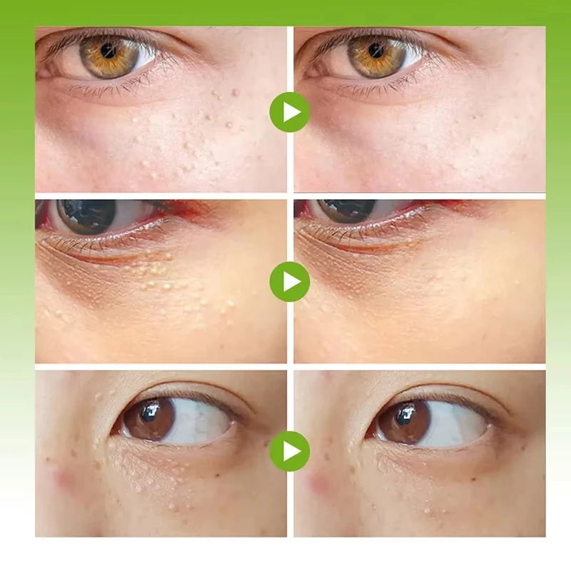 Creme para remoção de grânulos de gordura , ação delicada na área dos olhos