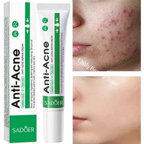 Pomada para tratamento de acne, reparação de manchas de espinhas, faz limpeza profunda dos poros. Poderoso anti-acne cicatrizante.