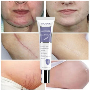 Creme Avançado Redutor de Cicatrizes