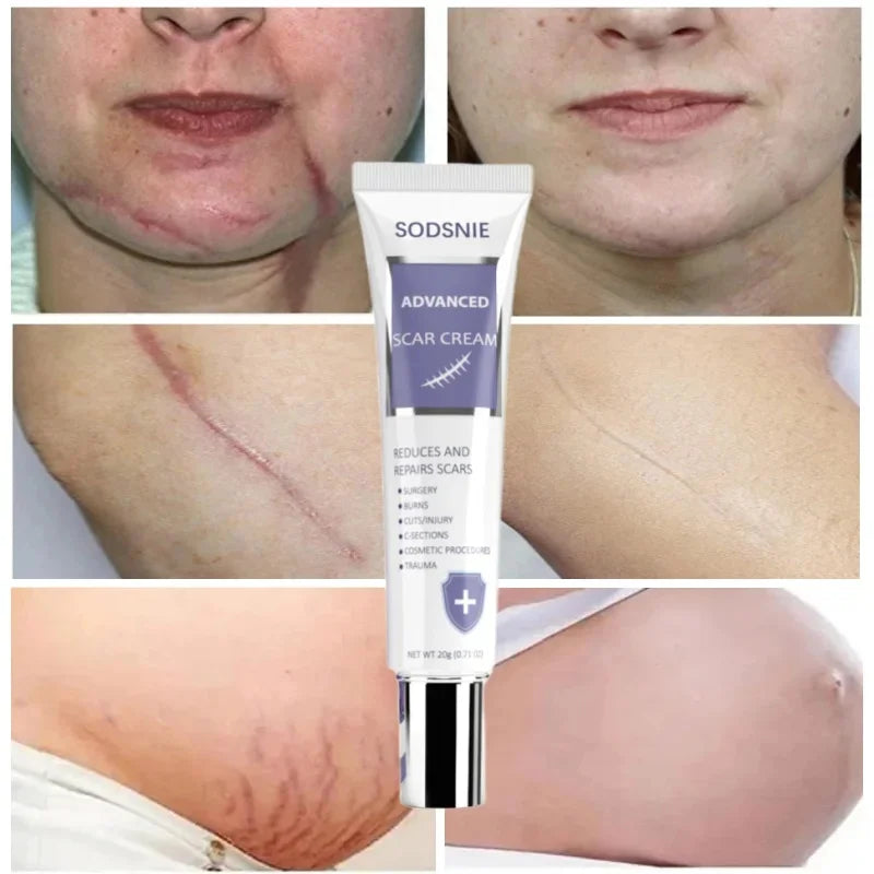 Creme Avançado Redutor de Cicatrizes