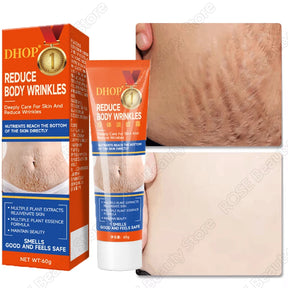 Creme de remoção permanente de estrias e anti-rugas