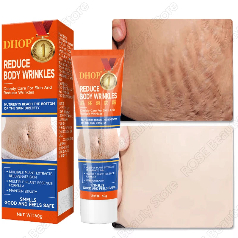 Creme de remoção permanente de estrias e anti-rugas