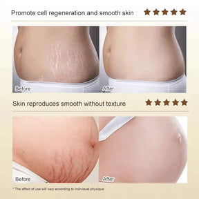 Creme de remoção permanente de estrias e anti-rugas