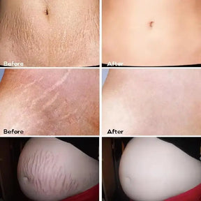 Creme de remoção permanente de estrias e anti-rugas
