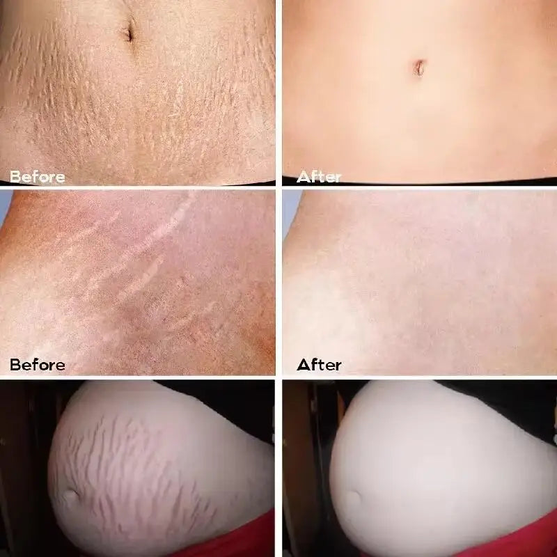 Creme de remoção permanente de estrias e anti-rugas