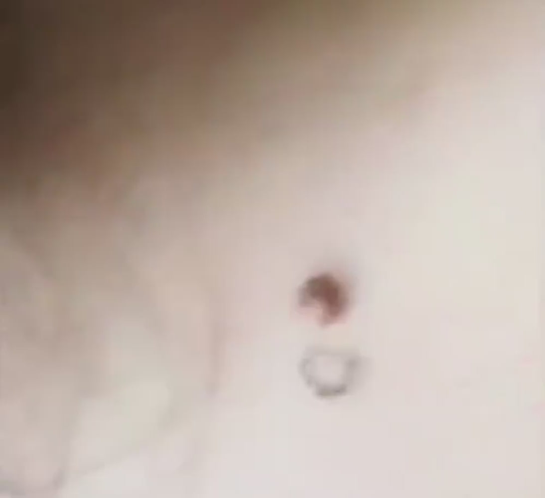 Caneta a Laser que remove manchas escuras, sardas, verrugas e até tatuagem