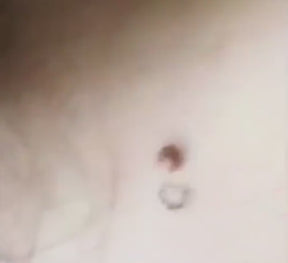 Caneta a Laser que remove manchas escuras, sardas, verrugas e até tatuagem