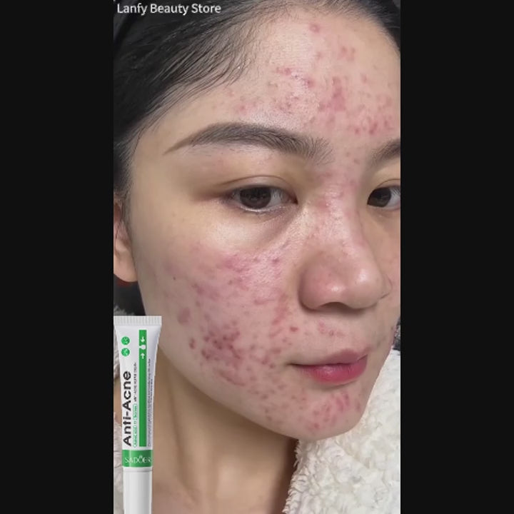 Pomada para tratamento de acne, reparação de manchas de espinhas, faz limpeza profunda dos poros. Poderoso anti-acne cicatrizante.